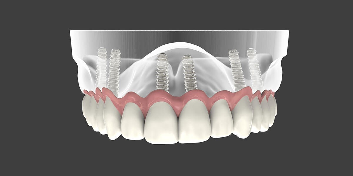 Types Of Partial Dentures Des Moines IA 50335
